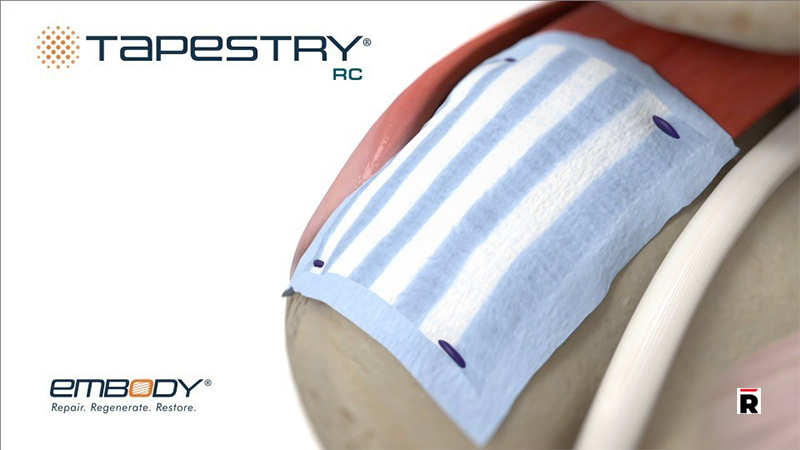 Embody_ Inc. Announces 510(k) Clearances for TAPESTRY® RC for Rotator Cuff Repair/Read Magazine